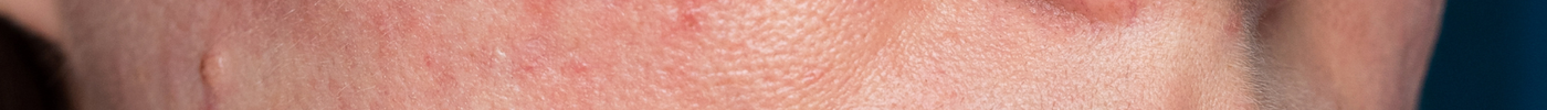 Lupus Rash vs. Rosacea: How to Tell the Difference