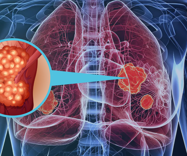 can smoking cigarettes cause popcorn lung Popcorn Lung: What is It, and What Makes You at Risk of Having It? – Aussie Pharma Direct can smoking cigarettes cause popcorn lung Popcorn Lung: What is It, and What Makes You at Risk of Having It? – Aussie Pharma Direct