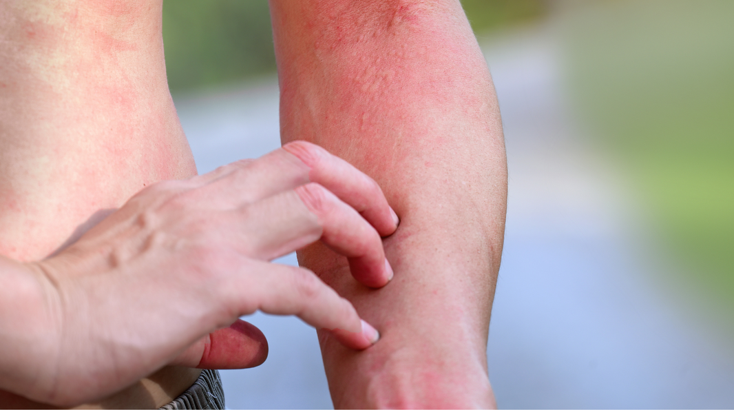 Extreme Rash Rashes 101: Everything You Should Know about Skin Rashes – Aussie ...