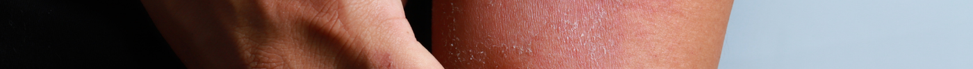 Top 10 Common Triggers of Eczema Flare-Ups & How to Avoid Them