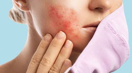 Woman having skin problems from wearing face mask