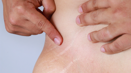 How to Get Rid of Stretch Marks without Medical Procedures