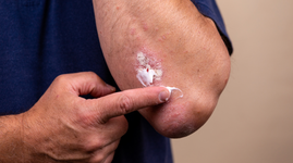 Man with eczema putting on cream for relief
